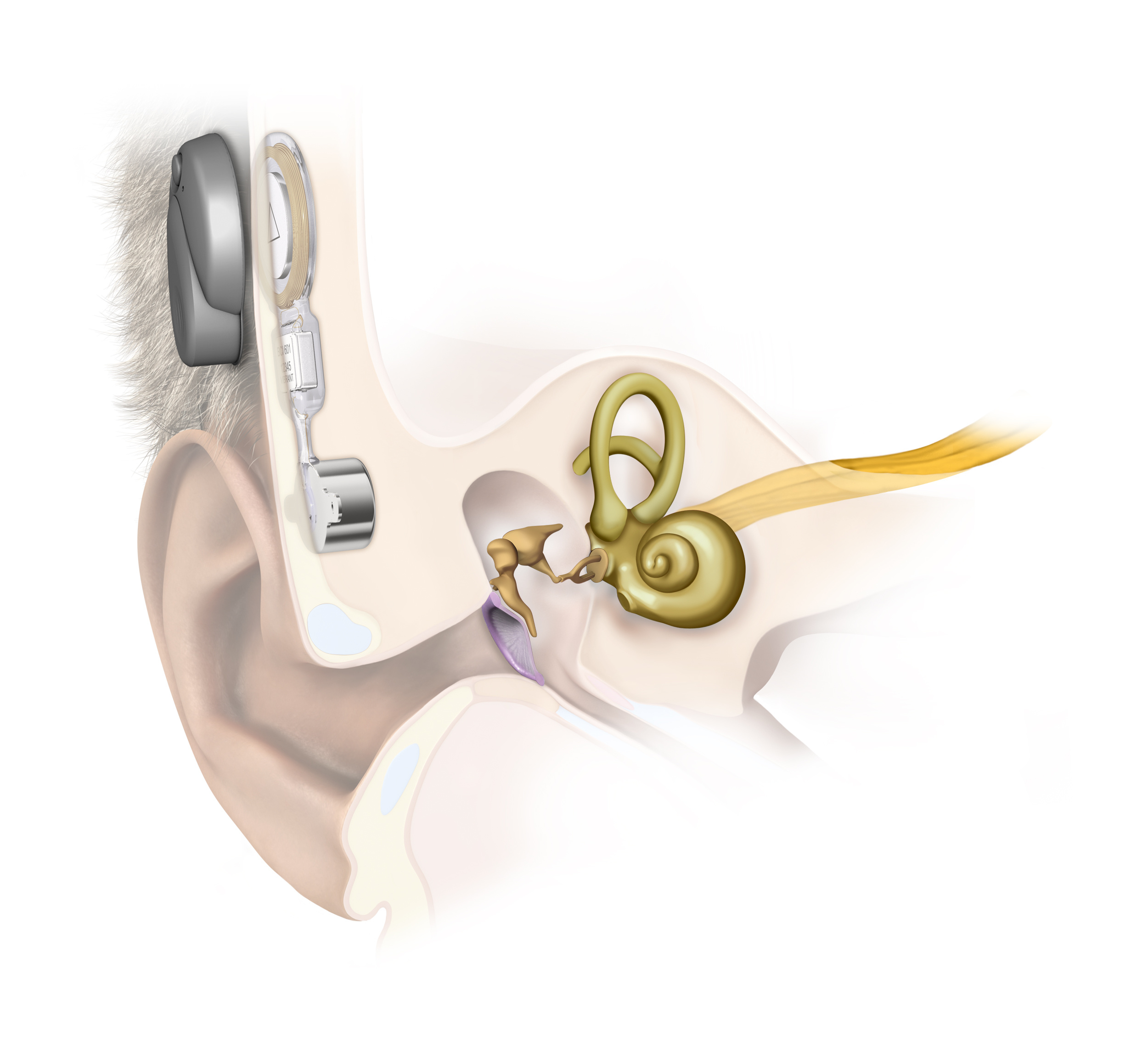 Слуховой аппарат внутреннего уха. Имплант среднего уха vibrant SOUNDBRIDGE. Слуховой аппарат кохлеарный имплант операция. Рентген кохлеарный имплант. Слуховой аппарат Кохлер имплант.